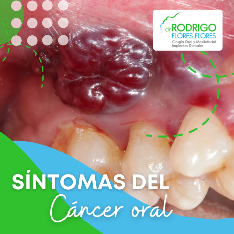 Síntomas del Cáncer oral