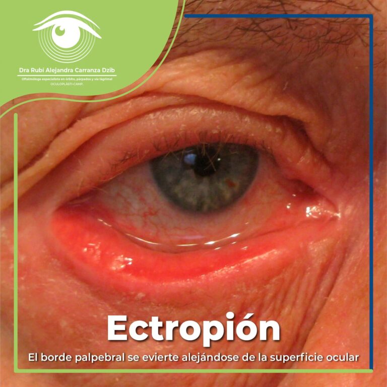 Ectropión