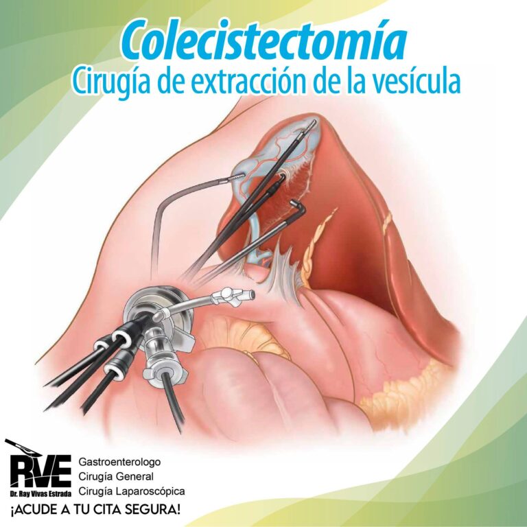 Colecistectomía