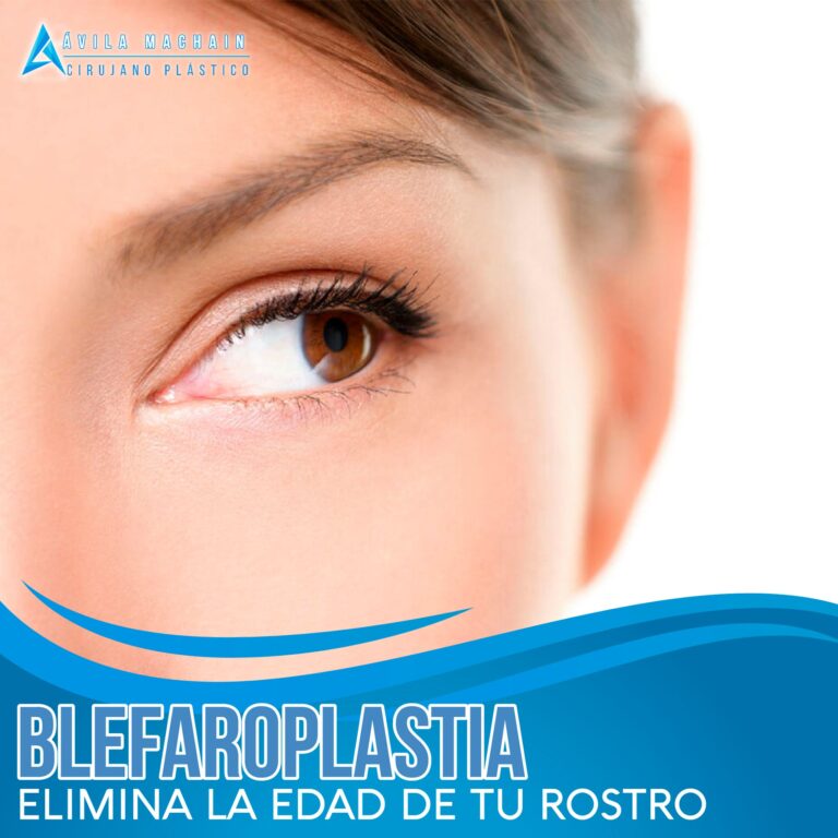 Blefaroplastia.