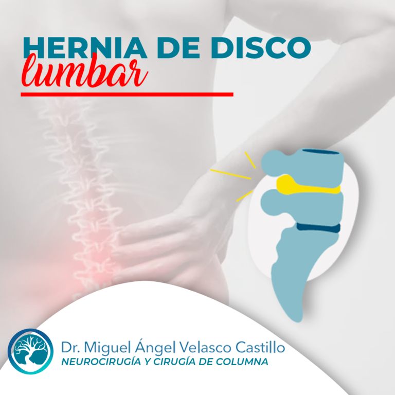 Hernia de disco.