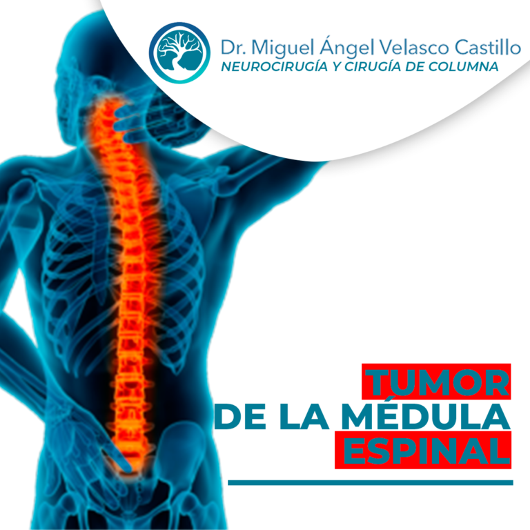 Tumor de la médula espinal