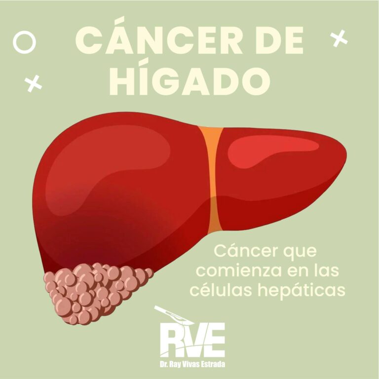Cáncer de hígado