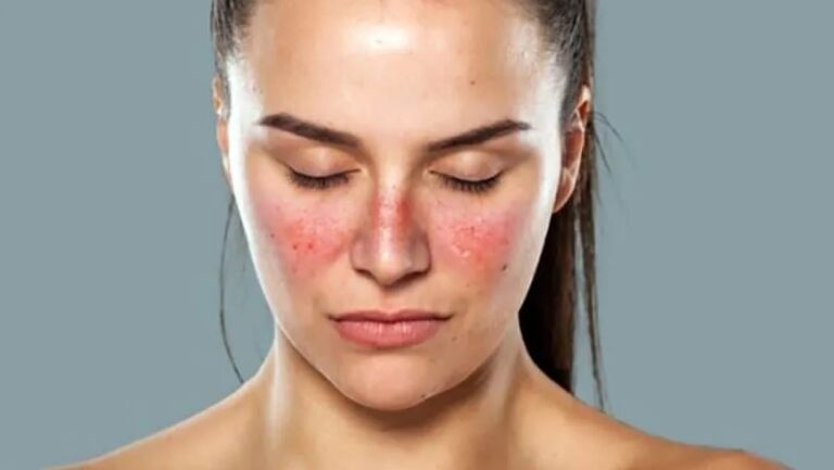 Lupus: la importancia del tratamiento reumatológico