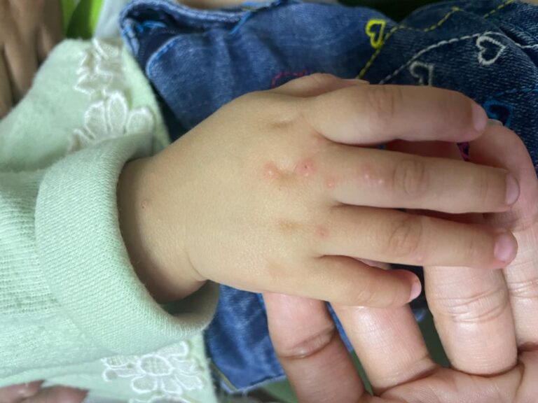 A PROPÓSITO DE LA CONSULTA DERMATOLÓGICA, HABLEMOS DE: ESCABIASIS