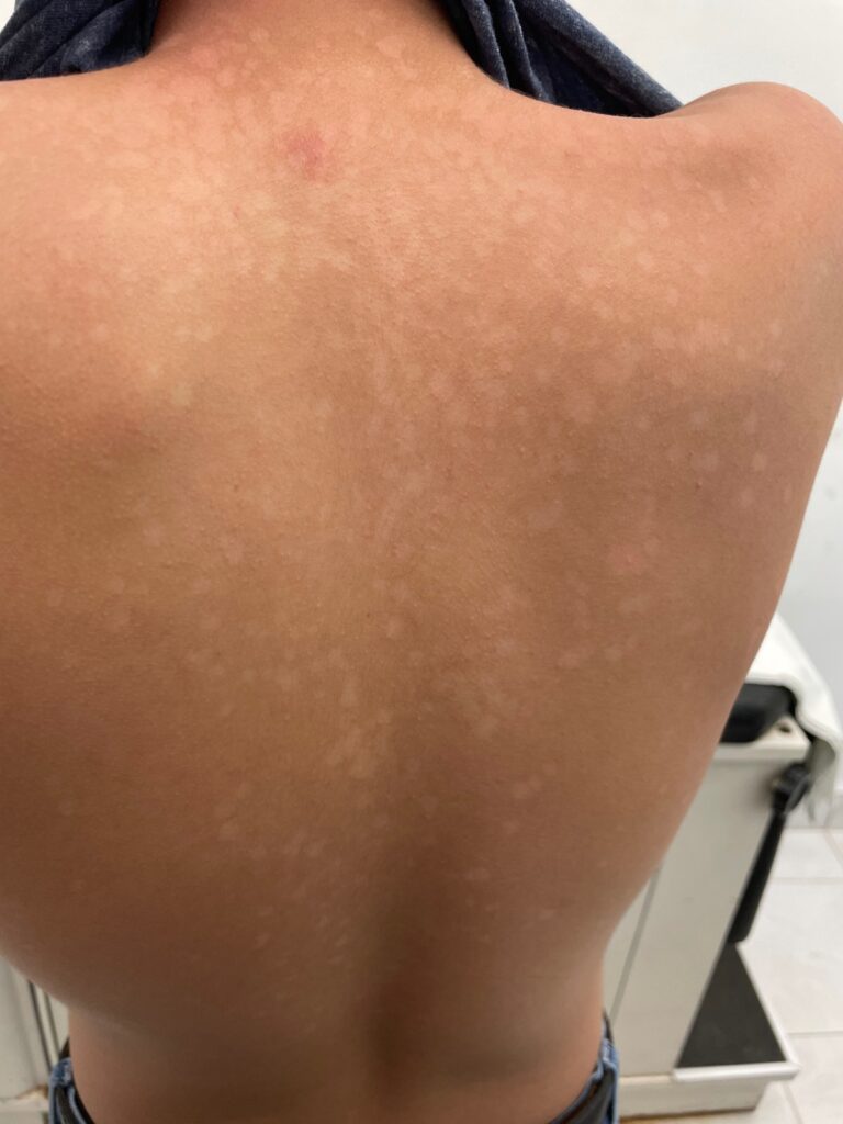 A PROPÓSITO DE LA CONSULTA DERMATOLÓGICA, HABLEMOS DE: PITIRIASIS VERSICOLOR