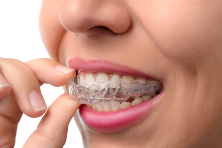 ¿Adiós a los Brackets? La ortodoncia invisible revoluciona tu sonrisa y tu autoestima