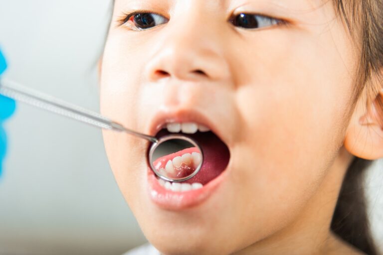 Patología bucal en la primera infancia: un tema de salud pública silencioso